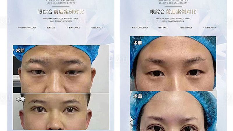 超声炮去眼袋：揭秘技术原理及术后注意事项