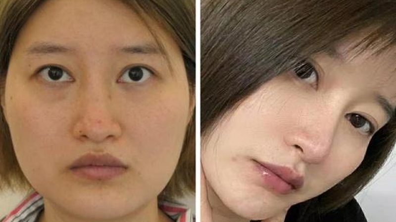 西安削骨手术：揭秘价格构成与选择要点