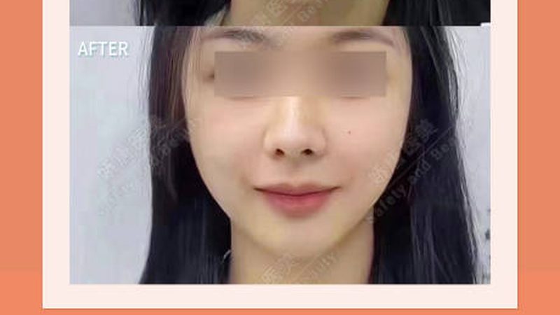 男性隆鼻面部刚毅感协调