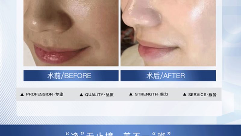 热玛吉2025：揭秘操作流程与价格构成
