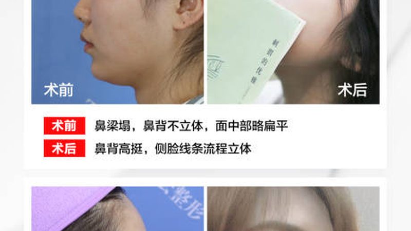 激光祛斑加盟，费用明细揭秘