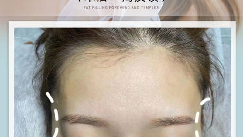 美容院激光脱毛机：揭秘选购背后的技术奥秘