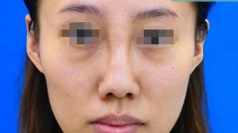 双眼皮术后多久可以洗脸