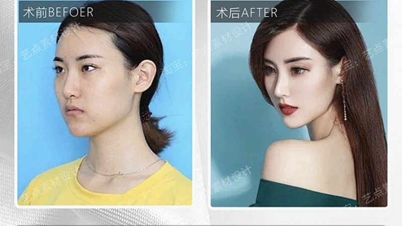 激光美容后出现反黑现象，常见的原因有以下几点：