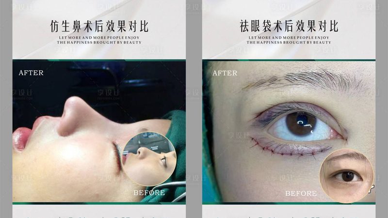 激光治疗黄褐斑：揭秘治疗流程与恢复期