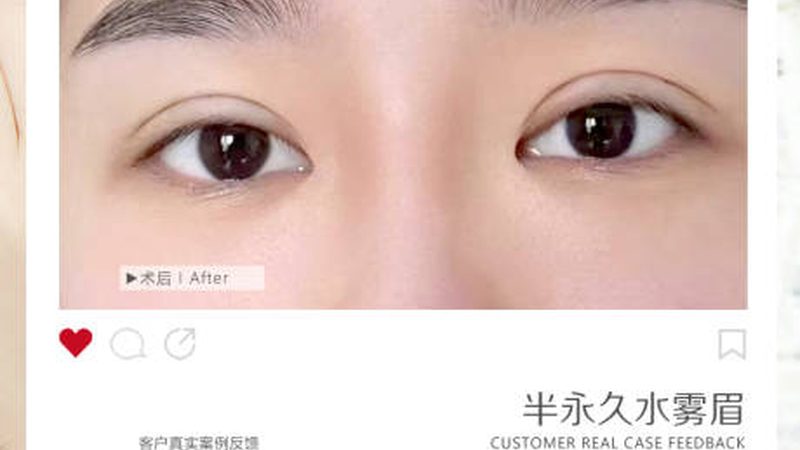 光子嫩肤：如何选择合适的仪器型号？**